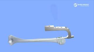 Universal Humerus Nail Uhn