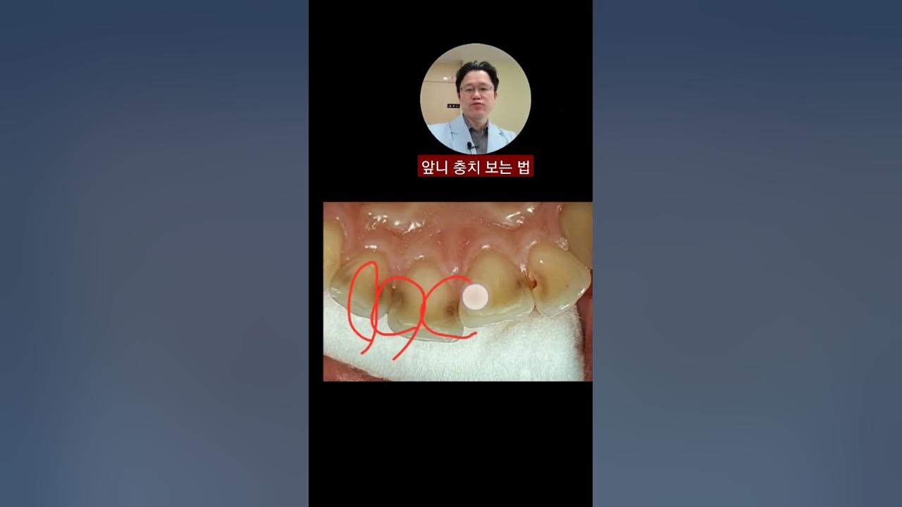 3초면 앞니 충치 진행 확인 ~ - Youtube