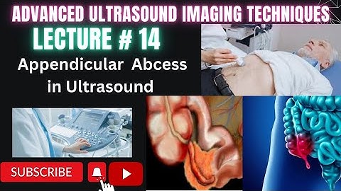 How to do appendix ultrasound Part 2 Appendicular abscess lecture 14 #ultrasound #technology#medical