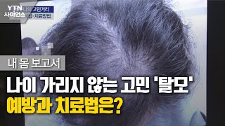 내 몸 보고서] 나이 가리지 않는 고민 '탈모'…예방과 치료법은?