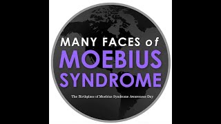 What is Moebius Syndrome