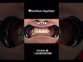 Miami Smile Makeover! ✨ Dental Blush Transformation