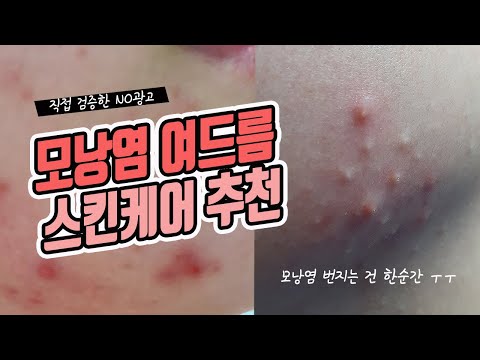 [NO광고] 모낭염 여드름 없애는 방법 화장품 뭐 쓰고 있으세요? 싹 없애준 고마운 공병템