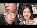 HOW I CLEARED MY SKIN |ACNE JOURNEY (struggles.self-confidence.skincare) Philippines