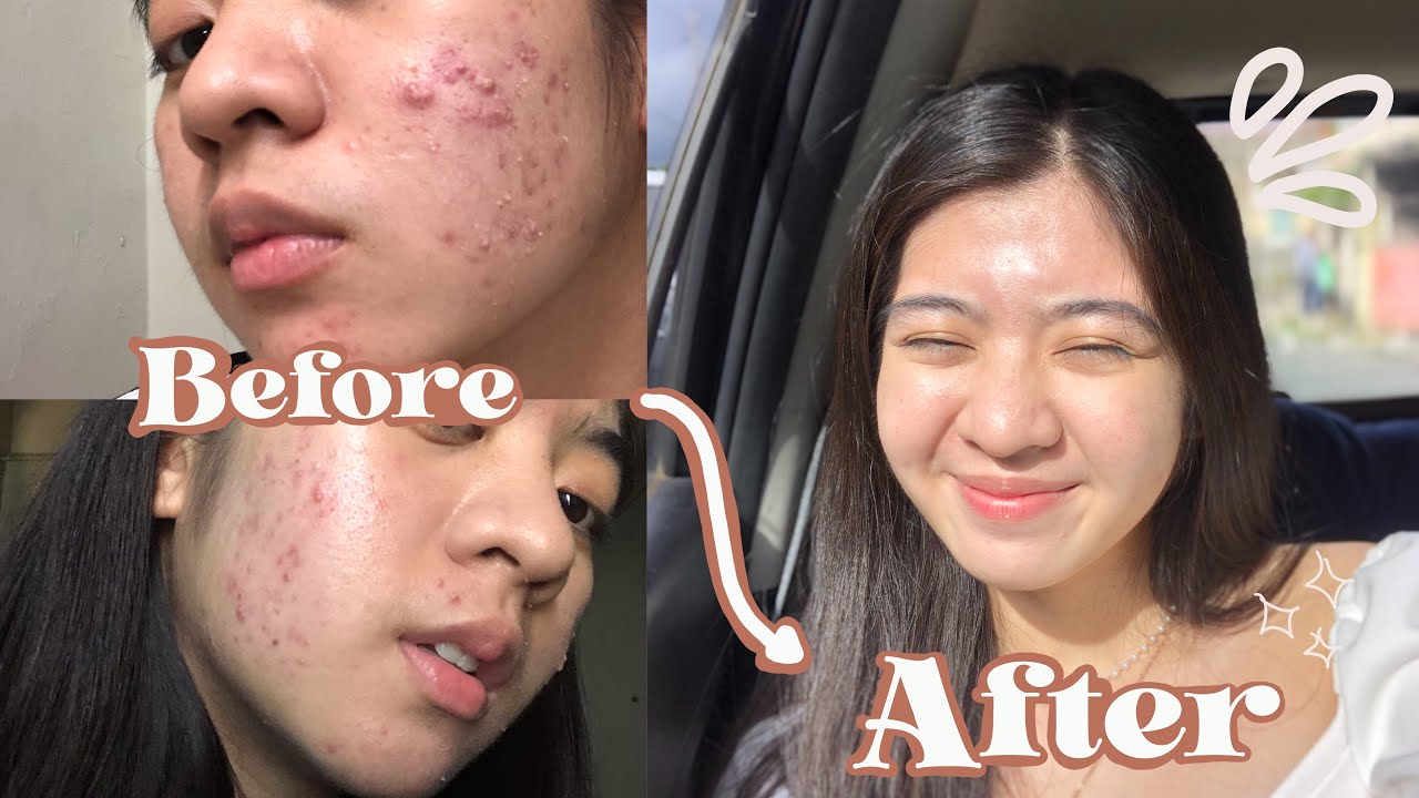 HOW I CLEARED MY SKIN ACNE JOURNEY (struggles.selfconfidence.skincare