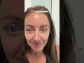 7 days post-op after an endoscopic brow lift, upper blepharoplasty, and fat grafting