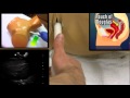 Transvaginal ultrasound from one minute ultrasound