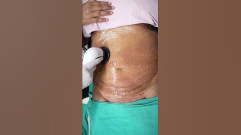 Abdomen Liposuction result | RF Session #shorts