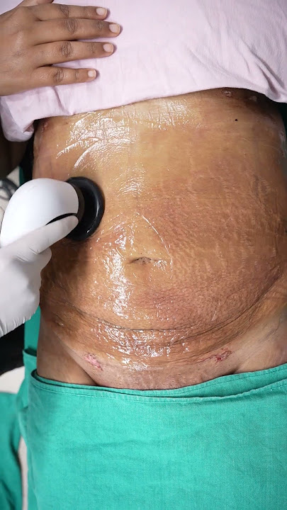 Abdomen Liposuction result | RF Session #shorts