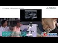 Case study posterior shoulder scan for glenohumeral joint