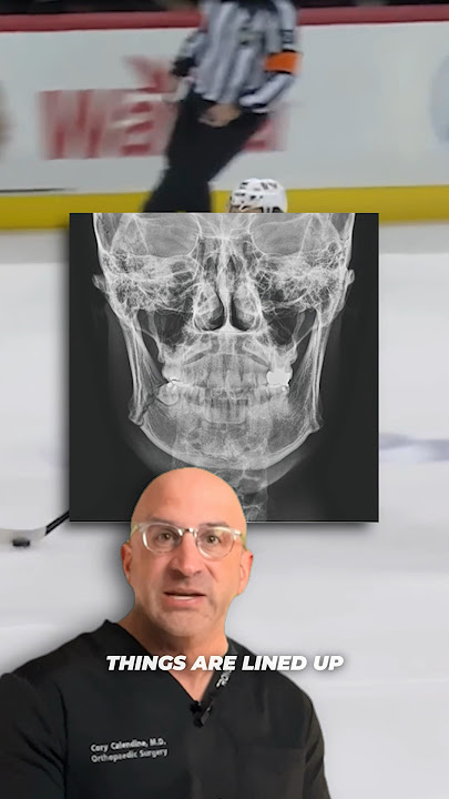 Bedard Broken Jaw Injury #shorts