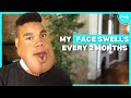 My Giant Facial Tumour Won’t Stop Me Dancing | BORN DIFFERENT