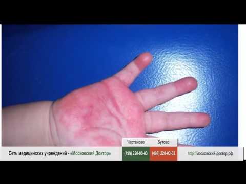 Аллергия на ладонях