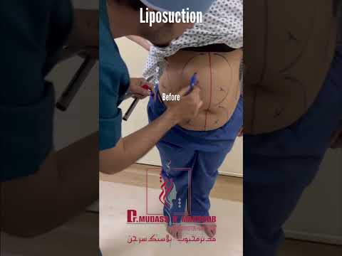 Wideo: Czym jest konturowanie brzucha?