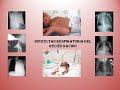 Dificultad respiratoria en el recién nacido