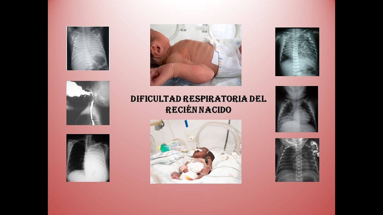 Dificultad respiratoria en el recién nacido YouTube Dificultad respiratoria en el recién nacido YouTube