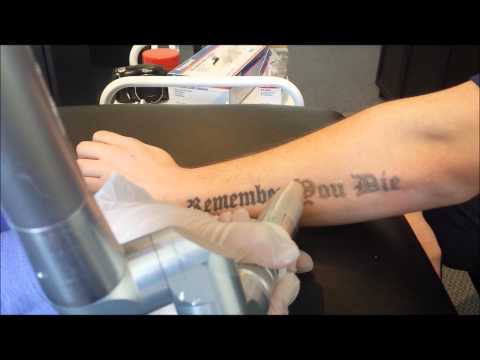 3rd Laser tattoo removal session August 16th 2014 Doovi