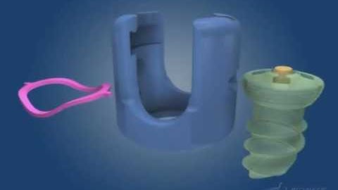 P 420 B Quantum Spinal System Polyaxial Screws and Locking C