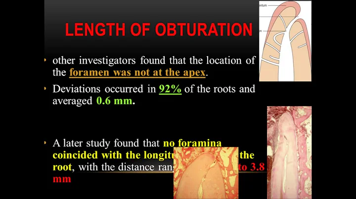 Root canal obturation (2) dr mazen douman