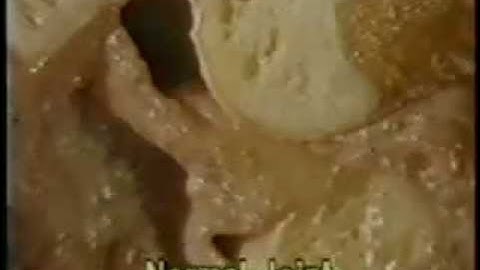 TMJ: Normal Anatomy