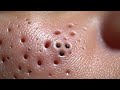 #PoreZen #BlackheadRemoval #PimplePopping #ASMRBlackhead 75