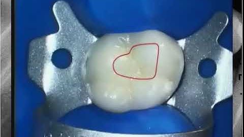 Ruddle Retreatment Series 1