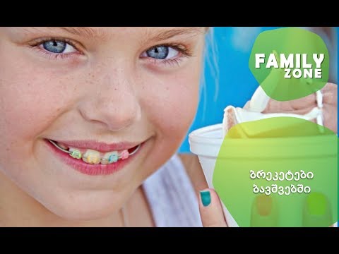 ყველაფერი ბრეკეტების შესახებ/ექიმი-სტომატოლოგი, თამარ მაჭარაშვილი.