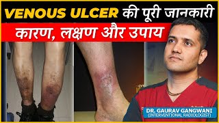 Complete Information of Venous Ulcer (Chronic Venous Insufficiency) | Dr. Gaurav Gangwani (IR)
