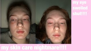 my skin care nightmare (storytime)