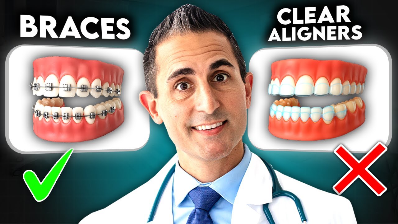 Металлические брекеты или прозрачные элайнеры: что быстрее в 2025 году?