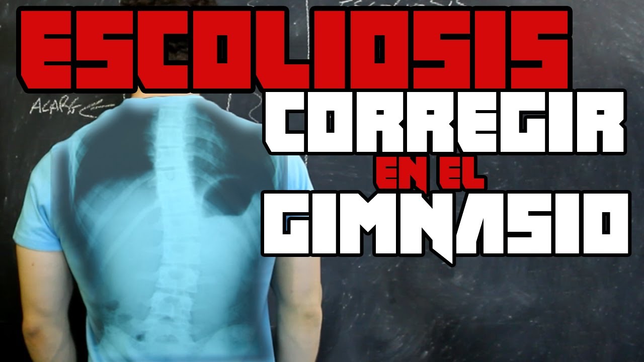 Escoliosis se puede corregir