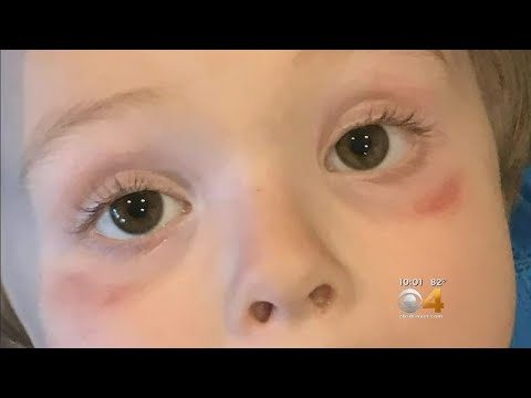 Lawsuit Claims Daycare Used Magic Eraser On Children's Faces