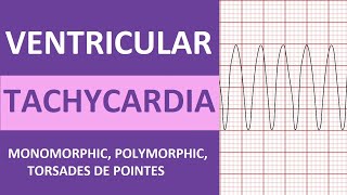 Ventricular Tachycardia (V-tach) ECG Interpretation, Treatment, Nursing NCLEX Review