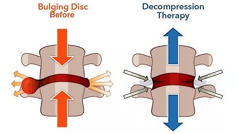 Decompression CPT codes - simplify medical coding