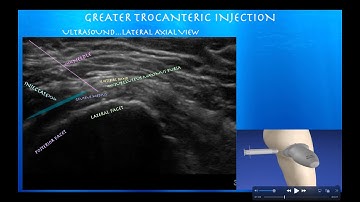 Ultrasound Guided Hip Greater Trochanteric Bursa Injection