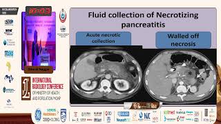CT Imaging Features of Pancreatitis
