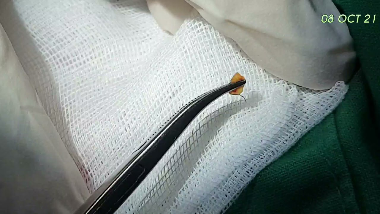 sweat gland infection, 한선염 YouTube