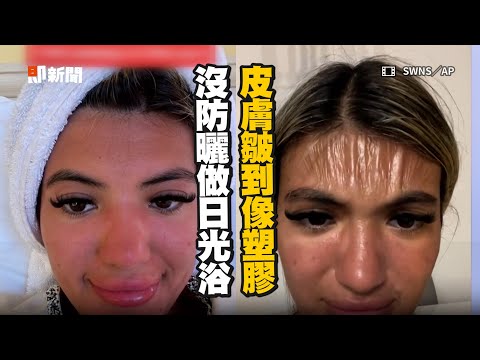 沒防曬做30分鐘日光浴！皮膚「皺成塑膠」嚇壞｜脫皮｜曬太陽｜紫外線