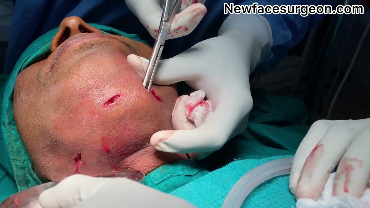 Ludwigs angina Incision and Drainage