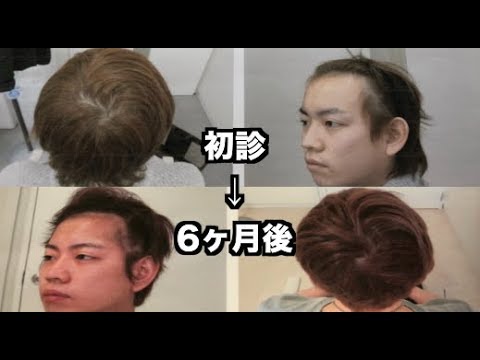 ハゲ日記 Aga薄毛治療６ヶ月目 Youtube