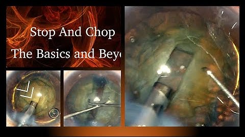 The Stop and Chop technique of phacoemulsification - The Basics and Beyond