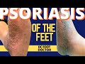 Psoriasis and the Feet, Part 2: Treating Pustular Psoriasis of the Skin