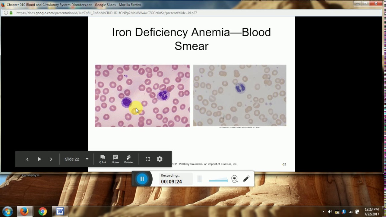 Pathophysiology Chapter 10 Blood Disorders YouTube Pathophysiology Chapter 10 Blood Disorders Youtube