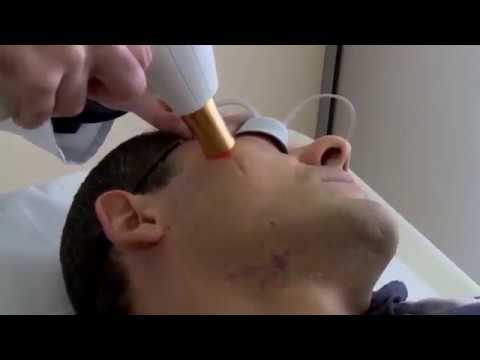 Video: Trattamento Laser Per Cicatrici: Costo, Efficacia, Viso E Altro