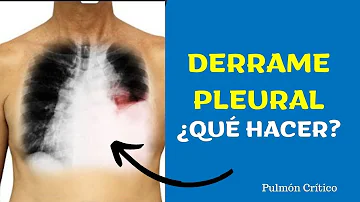 ¿Cuánto tiempo se puede vivir con derrame pleural?