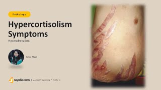 Hyperadrenalism | Hypercortisolism Symptoms | Medical Student Pathology Education