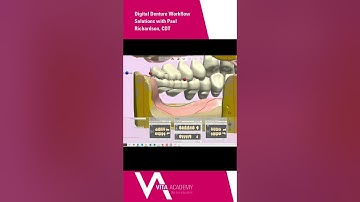 Digital Denture Workflow Solutions with Paul Richarson, CDT