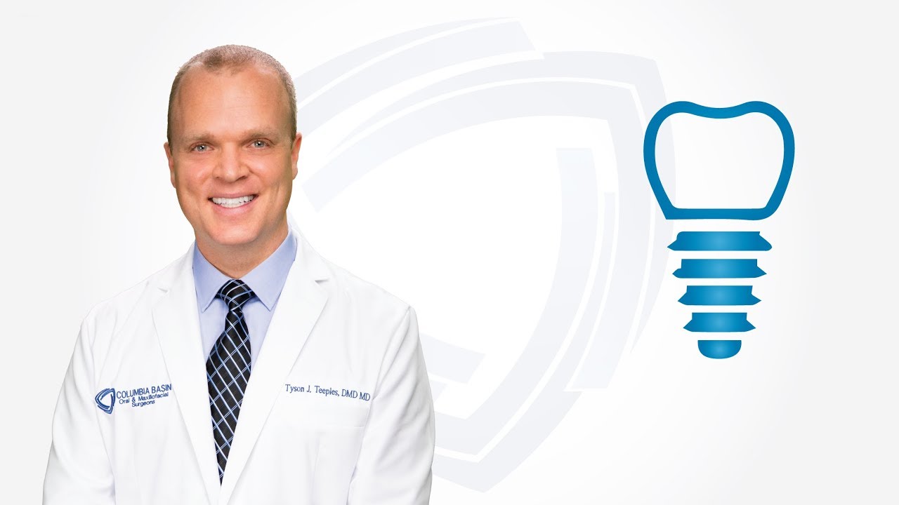 Dental Implants Quality in Kennewick WA Dr. Teeples Columbia Basin