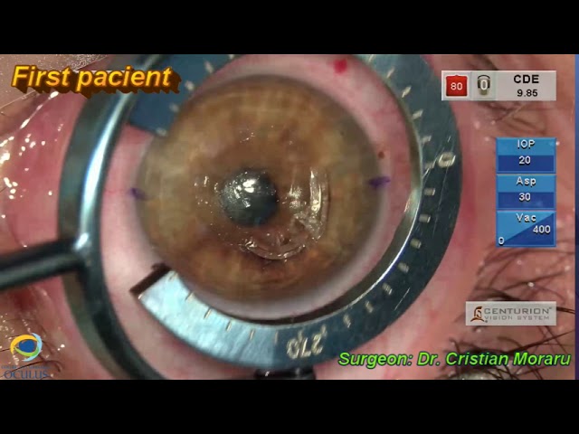Keratoconus and its Modern Treatments - Moorfields Eye Hospitals UAE