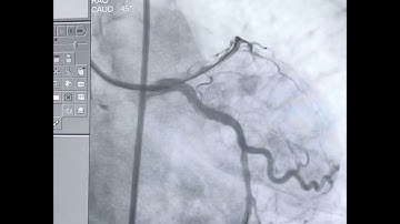 Case 10:- LAD cto angioplasty with antegrade wire technique